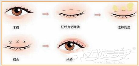 苏州圣爱韩式双眼皮手术图解