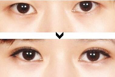 西安艾美韩式双眼皮案例
