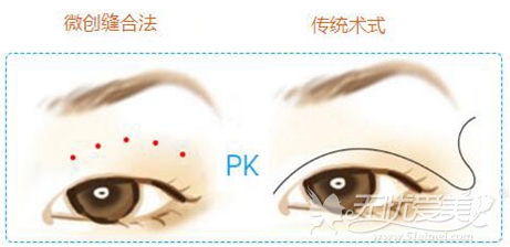 郑州欧兰整形双眼皮手术缝合优势