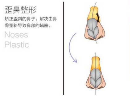 济宁韩美歪鼻矫正