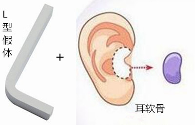 广州军美“L”型硅胶假体+耳软骨