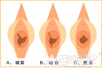 温州东方女子医院处女膜修复技术恢复过程