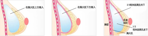 广州韩妃仿生隆胸手术方法