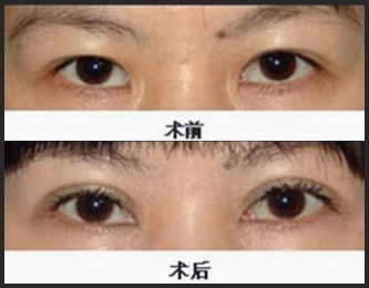 锦州锦美韩式三点双眼皮手术前后对比