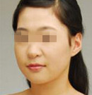 南京康美注射瘦脸针整形案例