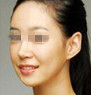 南京康美注射瘦脸整形案例