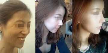 Lydia右侧面术前术后对比照