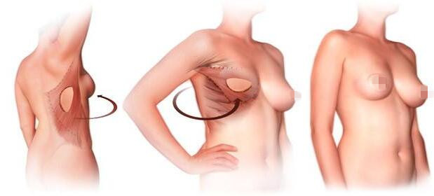 北京八大处乳房再造术方法