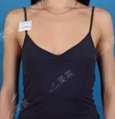 【真人秀】法国美女在天津美莱假体隆胸全过程 罩杯从A升C