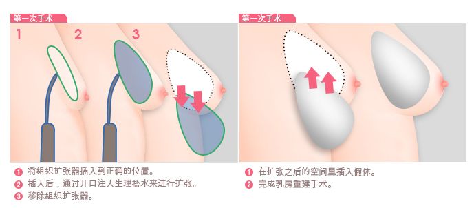 乳房再造术需要进行两次手术