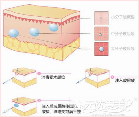 长沙雅美玻尿酸注射