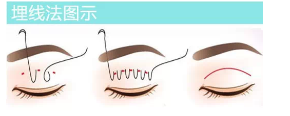 新疆高丽汉白埋线双眼皮修复过程