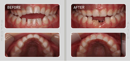 儿童牙齿正畸前后对比案例