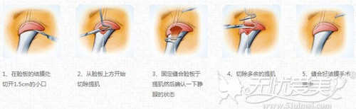 神经性上睑下垂手术方法