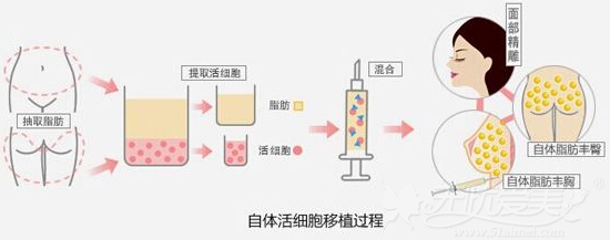 韩国will整形外科自体脂肪移植过程