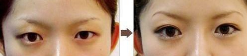 乌鲁木齐大西北双眼皮手术案例