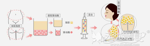 郑州颜图丽人整形自体脂肪丰胸