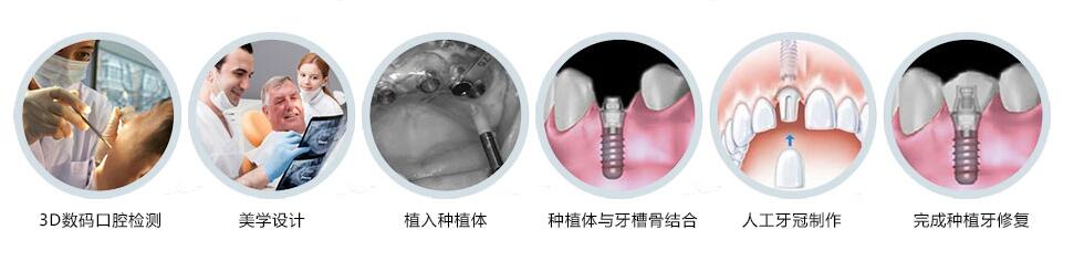 郑州植得口腔3D微创种植牙流程