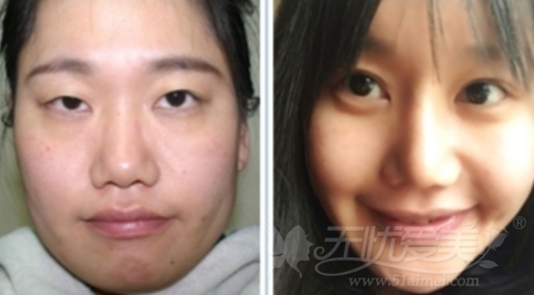 【案例分享】在韩国灰姑娘医院做完面部轮廓 大饼脸变小脸