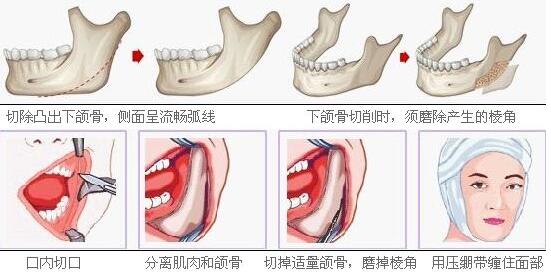 韩国COOKI整形外科下颌角整形
