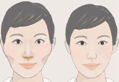 韩国COOKI整形外科面部轮廓手术