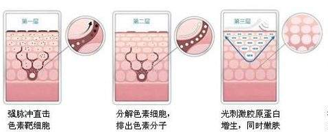 郑州童颜激光祛斑过程