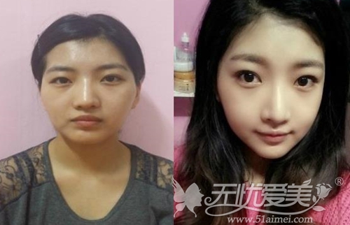 我在韩国巴诺巴奇做面部轮廓+眼鼻整形术后半年对比