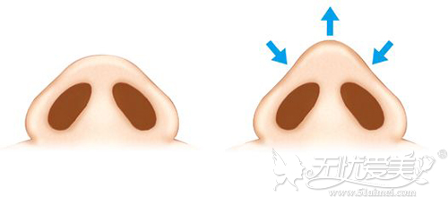 宁波徐建国鼻翼缩小整形术 让你的大鼻孔迅速消失