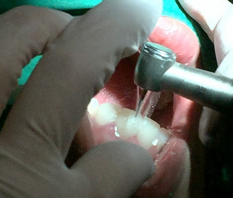 韩国优露牙科牙齿全瓷贴面手术