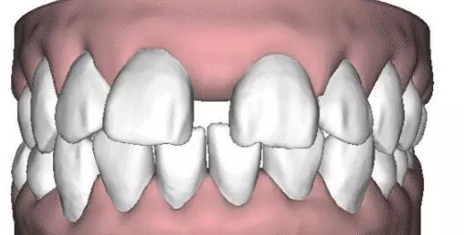 牙齿出现的一些问题