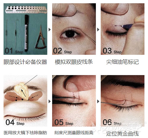 上海华美双眼皮手术医生佀同帅手术流程图