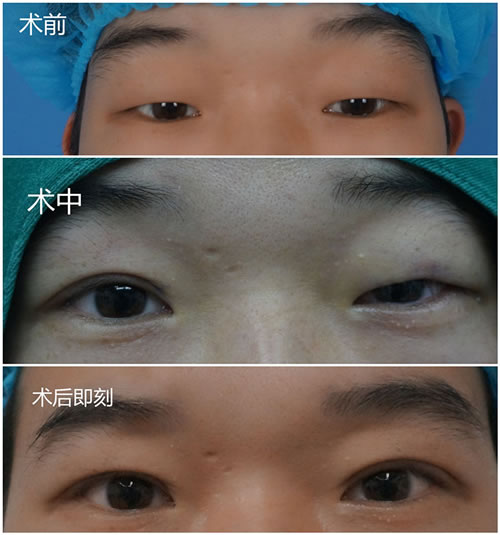 上海华美张朋主任成功案例之单眼皮变双眼皮前后对比图