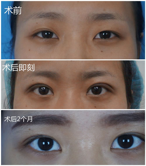 眼部整形医生张朋经典案例之不对称双眼皮术前术后对比图