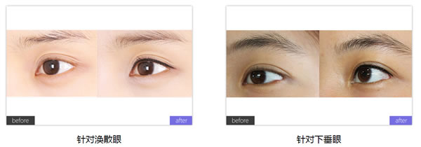 刘惠珍医生纹眼线术前术后对比案例图