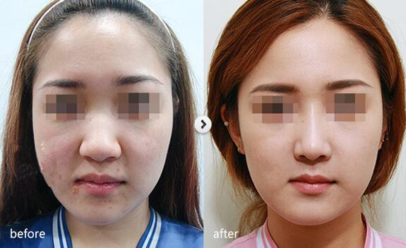 北京美玉颜鼻综合手术前后对比案例