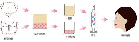 韩国REX整形外科自体脂肪移植原理