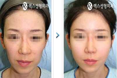韩国REX整形外科面部脂肪移植