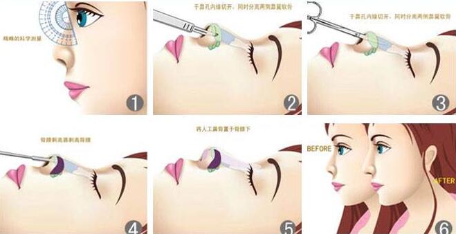 鼻综合手术过程原理