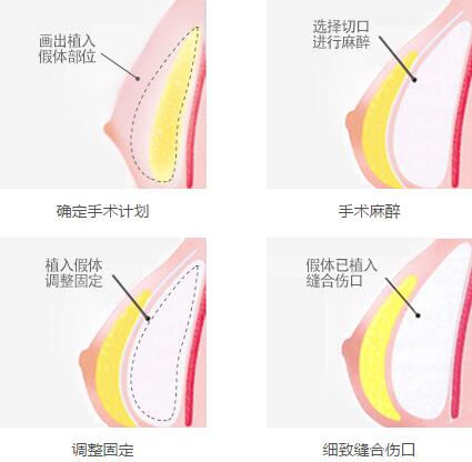 邢台仁爱整形医院隆胸术