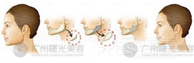 广州曙光下颌角磨骨术