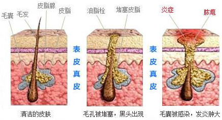 韩国美典皮肤科解析痘痘形成的原因