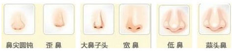 北京一美鼻整形能改善的鼻型