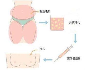 中国台湾爱尔丽整形医院自体脂肪丰胸