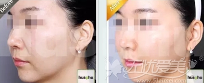 韩国HUSHU皮肤科水光+PRP案例