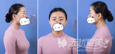 在上海华美做双眼皮手术前拍照