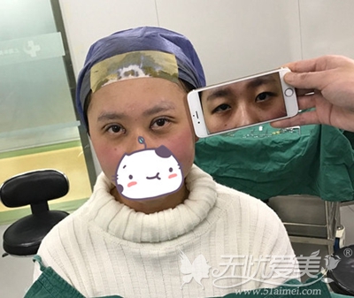 在上海华美做双眼皮手术中对比