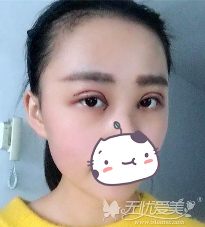 在上海华美做双眼皮手术后第2天