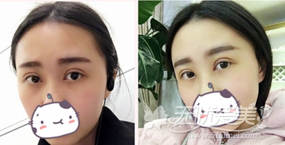 在上海华美做双眼皮手术后1-2周