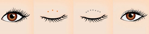 韩国TIAN整形埋线双眼皮手术方法