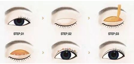 韩国TIAN整形切开双眼皮手术方法